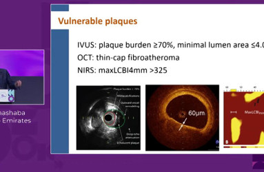 NIRS-guided PCI: beyond calcium to precision PCI 