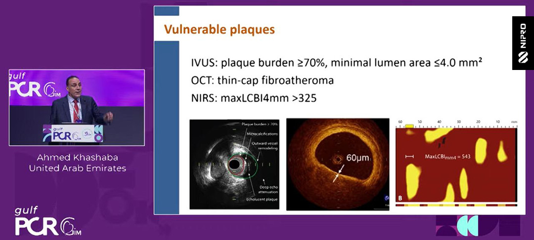 NIRS-guided PCI: beyond calcium to precision PCI 